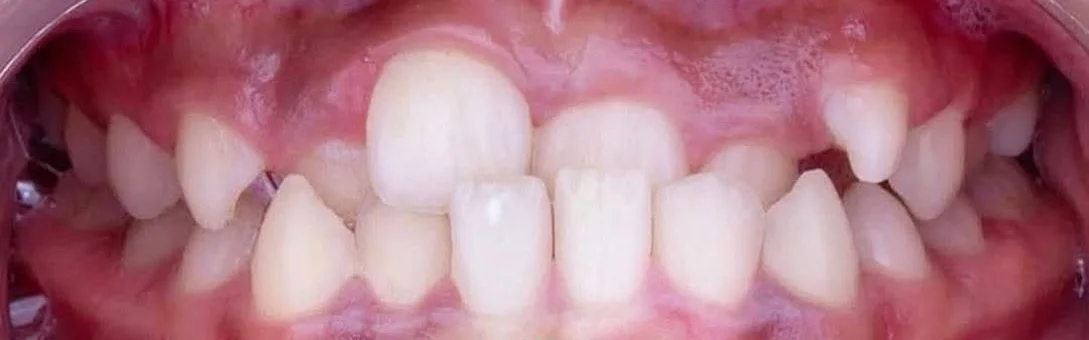Antes del tratamiento: dientes apiñados y desalineados