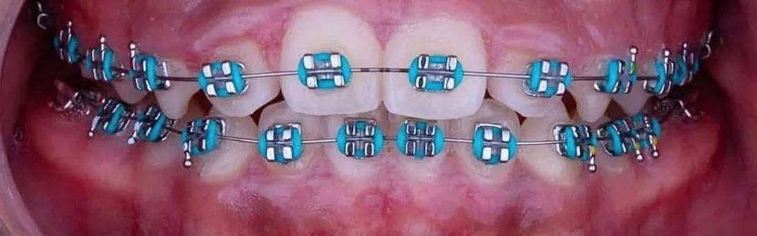 Después: dientes alineados con brackets metálicos en Mares Ortodoncia